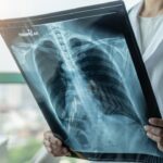 Malaysia risks under-reporting of TB cases as ‘slow-burn epidemic’ persists